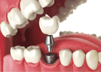 Implant dentar pentru un zambet cuceritor